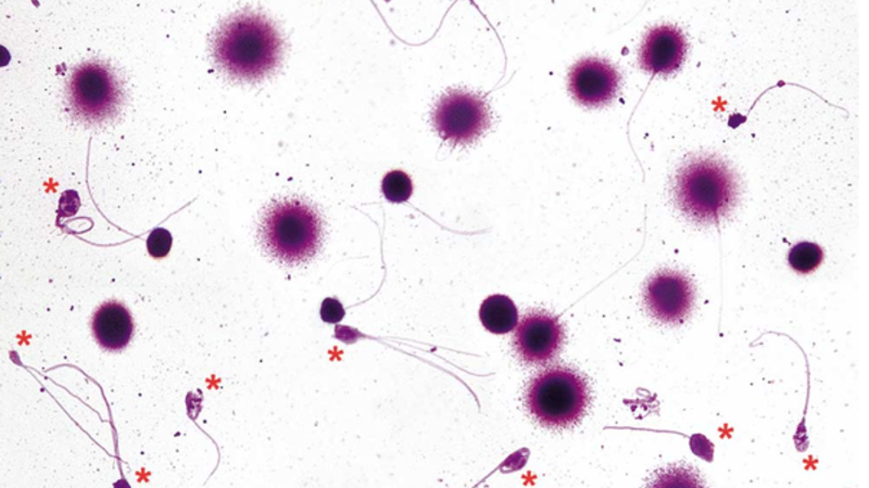 Фрагментация ДНК сперматозоидов не связана с эмбриологическими или клиническими исходами ЭКО/ИКСИ
