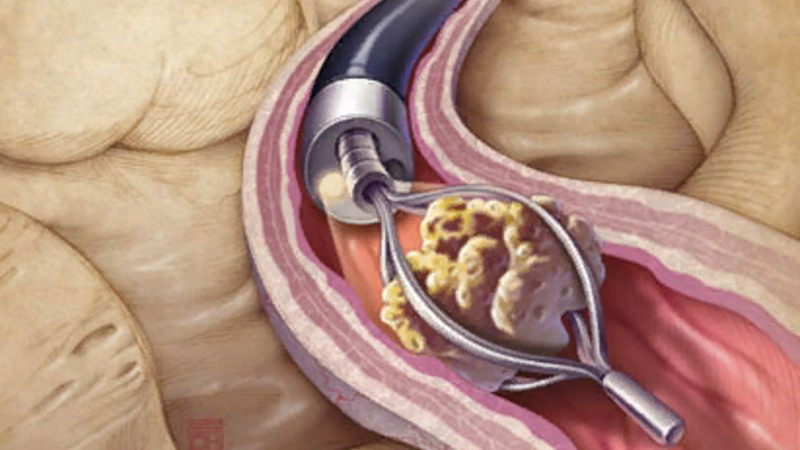 Разработка и валидация номограммы, позволяющей прогнозировать периоперационные осложнения после гибкой уретероскопии по поводу камней почек в случаях катетеризации мочеточника в течение ночи