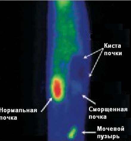 Нефросцинтиграфия