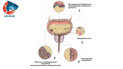 Микробиота мочи и рак мочевого пузыря: акцент на уропатогены
