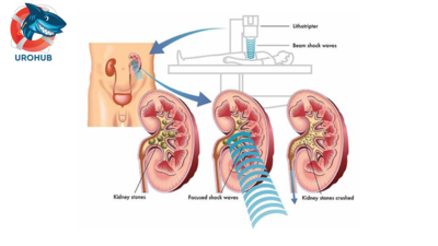 Экстракорпоральная ударно-волновая литотрипсия (ESWL) по сравнению с чрескожной нефролитотомией (PCNL) или ретроградной внутрипочечной хирургией (RIRS) при камнях почек