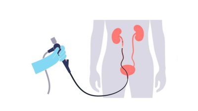 Возрастные особенности уролитиаза: данные систематического обзора об исходах уретероскопии у пожилых пациентов