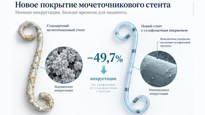 Новый мочеточниковый стент с минимальной инкрустацией
