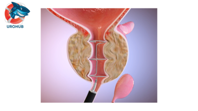 12-месячные результаты первого исследования системы Zenflow для лечения ДГПЖ