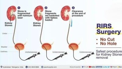 Меньше времени, выше эффективность: кто победит – гибкий миниперк или РИРХ?