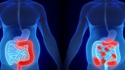 У пациентов с воспалительными заболеваниями кишечника и ИМП высокий риск развития осложнений