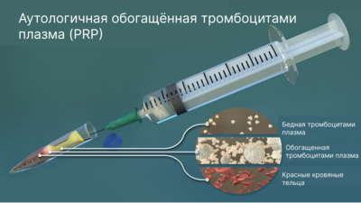 Краткий обзор по аутологичной тромбоцитарной плазме (PRP) при эректильной дисфункции (ЭД) 2025 г.