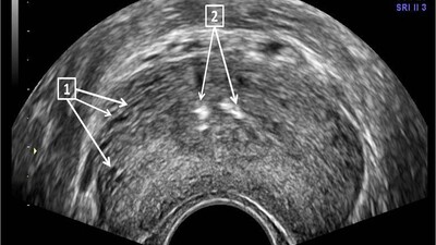 Парауретральная кальцификация ухудшает симптомы нижних мочевых путей