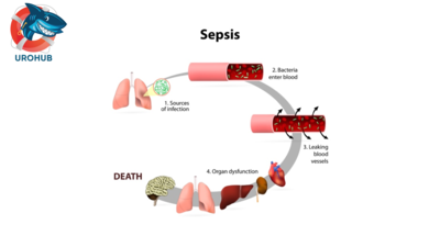 Механизм уросепсиса: взаимосвязь между внутрипочечным давлением и пиеловенозным обратным кровотоком