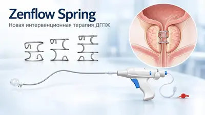 Zenflow Spring вышел в реальную клиническую практику США