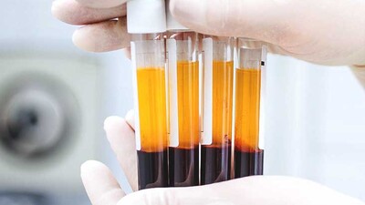 В чем особенность лечения ЭД обогащенной тромбоцитами плазмой?