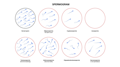 Новые данные о лечении олигоастенотератозооспермии: роль летрозола