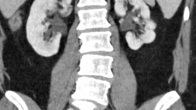 Стерильный рефлюкс приводит к почечным рубцам