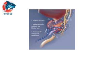 Изменение общенациональных тенденций отказа от чрезмерного лечения среди пациентов, перенесших радикальную простатэктомию за последние 25 лет