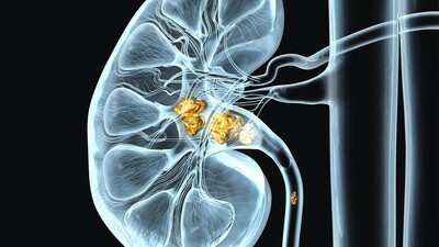 Нужно ли удалять мелкие бессимптомные камни?