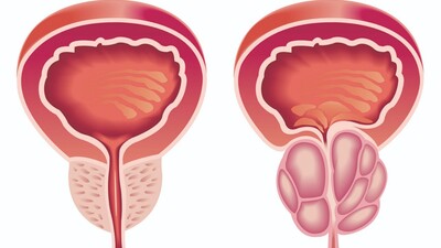 Развитие СНМП зависит от размера предстательной железы и ПСА