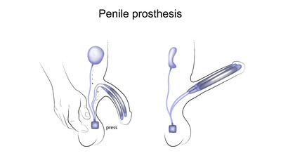 Протезирование при эректильной дисфункции: как снизить риски осложнений?
