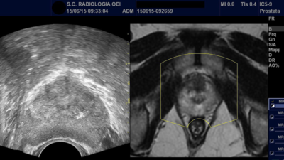 В новом исследовании ученые сравнили размер предстательной железы при МРТ и УЗИ
