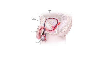 Анэякуляция и ретроградная эякуляция - обзор причин, методов диагностики и лечения