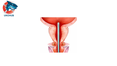 Недооцененное осложнение чистой интермиттирующей катетеризации