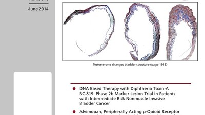 Морбидность, связанная с первичным использованием высоко-интенсивного фокусированного ультразвука, также повторного его применения у пациентов с локализованным раком предстательной железы