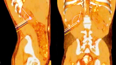 Как изменилась ПКНЛ в эру новых медицинских технологий?