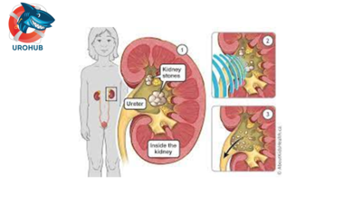 Эффективность ЭУВЛ при лечении камней в почках и мочеточниках у детей