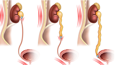 PASS-шкала: новый инструмент для прогнозирования самостоятельного отхождения камней мочеточника со стентом