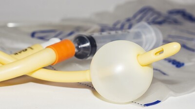 Удаление уретрального катетера при уретерореноскопической литотрипсии не приводит к осложнениям