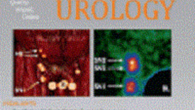 Влияние приема тадалафила на восстановление эректильной функции после двусторонней нервосберегающей радикальной простатэктомии: рандомизированное плацебо-контролируемое исследование (REACTT)