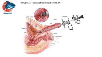Ранняя и отсроченная трансуретральная хирургия при острой задержке мочи (ОЗМ): имеет ли значение время?