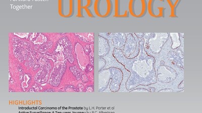 Сосудосберегающая лучевая терапия локализованного рака простаты для сохранения эректильной функции: одногрупповое исследование 2 фазы