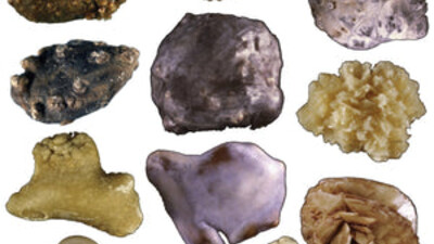 Селективная профилактическая терапия более эффективна у пациентов с рецидивирующей МКБ, по сравнению с универсальным подходом