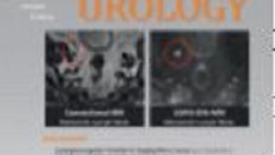 Сигнатура 36-ти генов прогнозирует клиническую прогрессию в подгруппе ERG-положительного рака предстательной железы