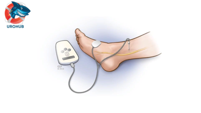 Сравнение транскутанной и перкутанной стимуляций большеберцового нерва при хроническом простатите категории IIIB/синдроме хронической тазовой боли: рандомизированное проспективное исследование