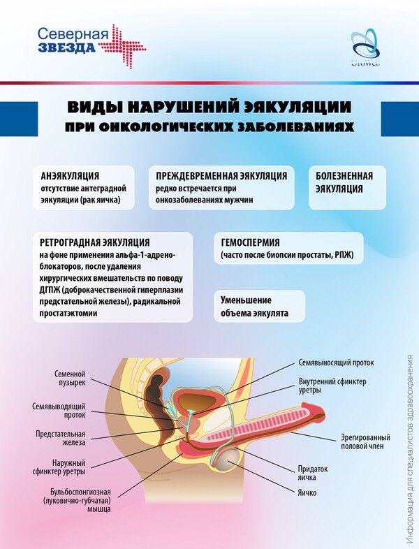 Нарушения эякуляции у онкологических пациентов