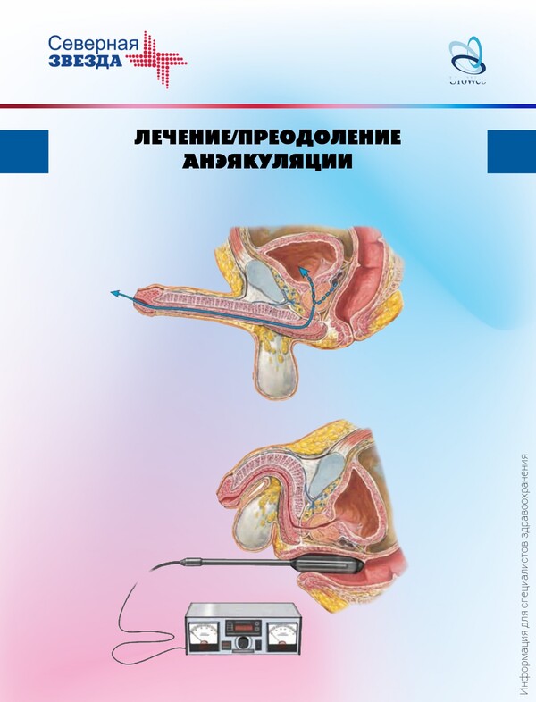 Нарушения эякуляции у онкологических пациентов
