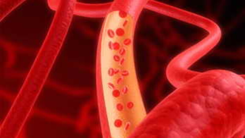 Атеросклероз повышает риск развития эректильной дисфункции