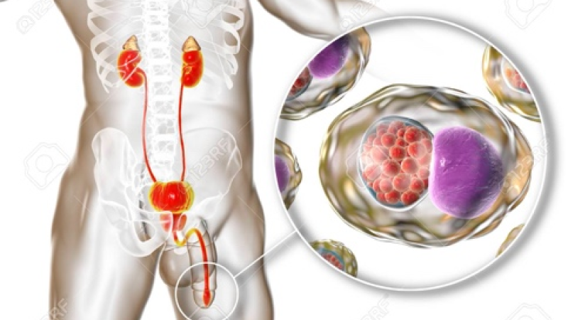 Хламидийная инфекция (Chlamydia trachomatis) в урологии