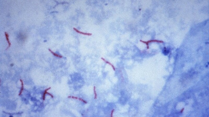 Туберкулез предстательной железы, маскирующийся под РПЖ