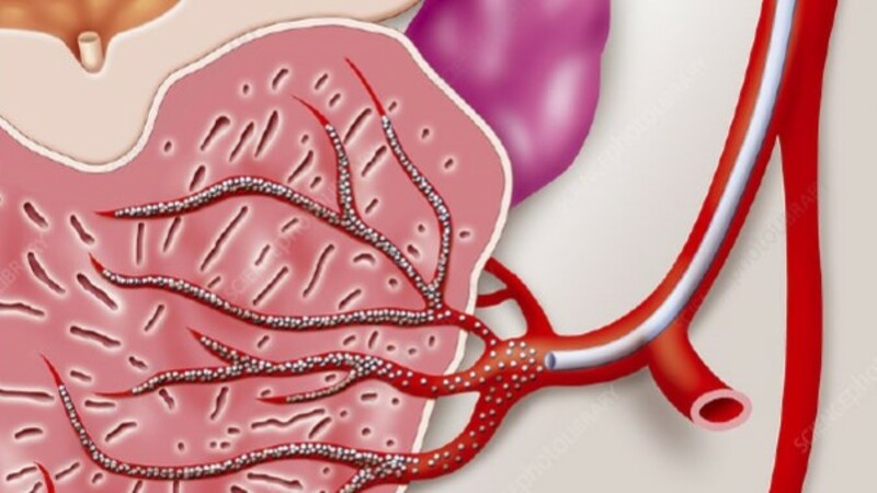 Оценка симптомов опорожнения и накопления после эмболизации артерии предстательной железы