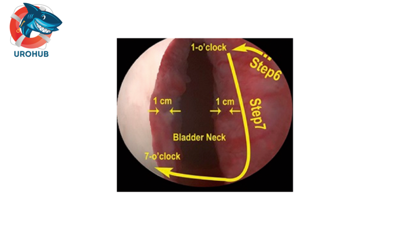 Результаты инцизии шейки мочевого пузыря во время гольмиевой лазерной энуклеации предстательной железы