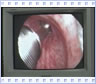 "UROSPIRAL2 (PORGES) в лечении больных с инфравезикальной обструкцией"