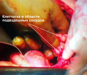 Клетчатка в области